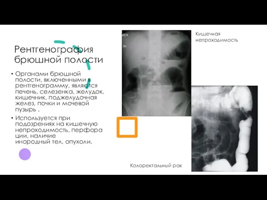 Рентгенография брюшной полости Кишечная непроходимость Колоректальный рак Органами брюшной полости,