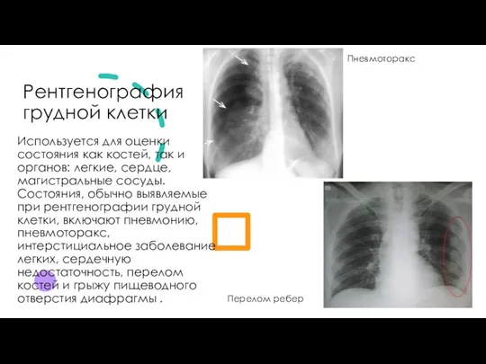 Рентгенография грудной клетки Используется для оценки состояния как костей, так