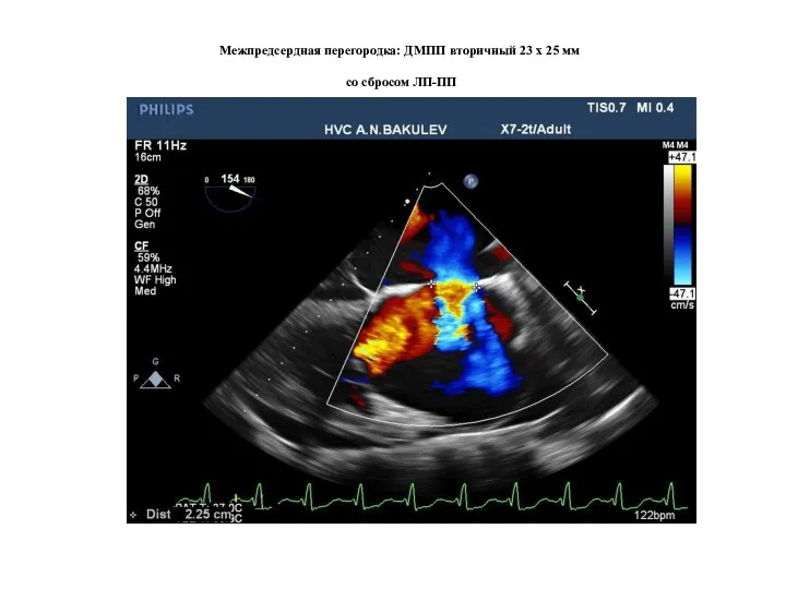 Межпредсердная перегородка: ДМПП вторичный 23 х 25 мм со сбросом ЛП-ПП