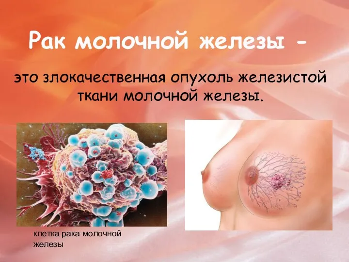 Рак молочной железы - это злокачественная опухоль железистой ткани молочной железы. клетка рака молочной железы