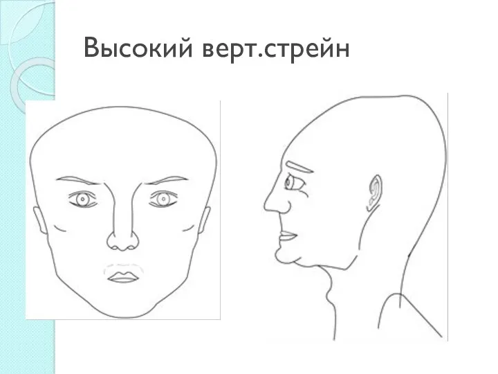 Высокий верт.стрейн