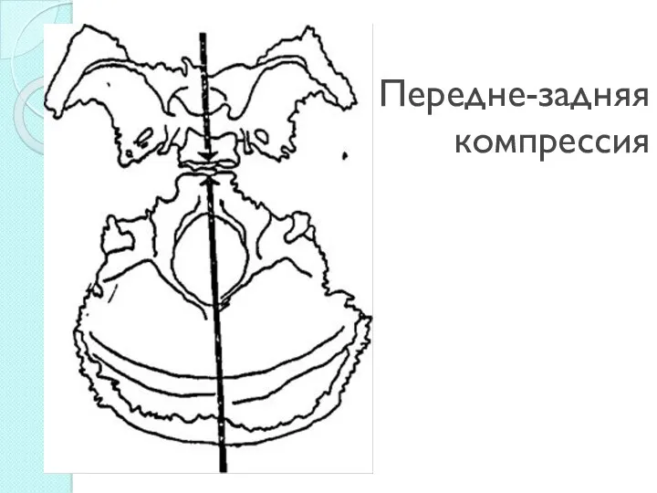 Передне-задняя компрессия