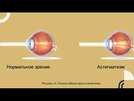 Рисунок 14. Глазное яблоко при астигматизме