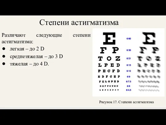 Степени астигматизма Различают следующие степени астигматизма: легкая – до 2