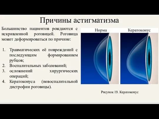 Причины астигматизма Большинство пациентов рождаются с искривленной роговицей. Роговица может