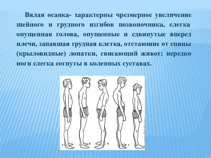 Вялая осанка- характерны чрезмерное увеличение шейного и грудного изгибов позвоночника,