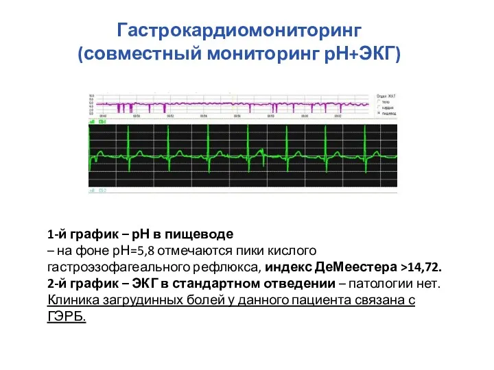 Гастрокардиомониторинг (совместный мониторинг рН+ЭКГ) 1-й график – рН в пищеводе