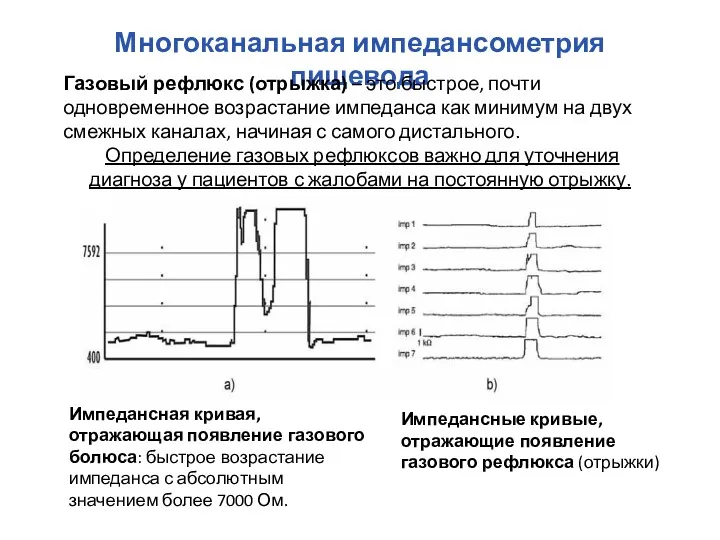 Многоканальная импедансометрия пищевода Импедансная кривая, отражающая появление газового болюса: быстрое