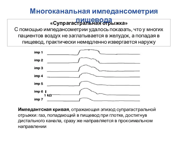 «Супрагастральная отрыжка» С помощью импедансометрии удалось показать, что у многих