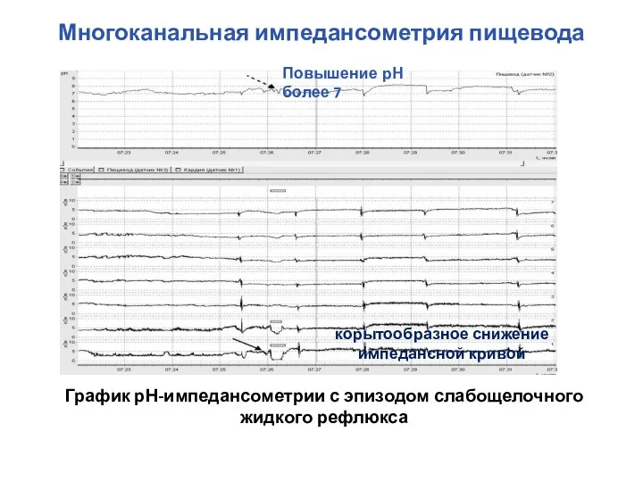 Многоканальная импедансометрия пищевода График рН-импедансометрии с эпизодом слабощелочного жидкого рефлюкса