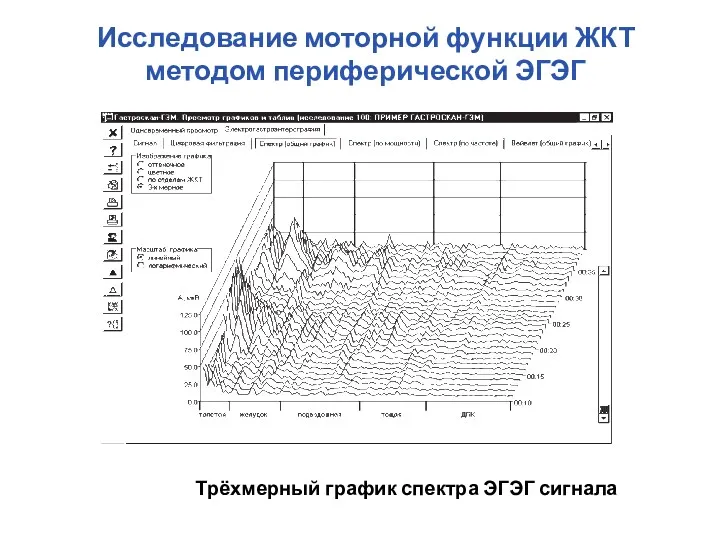 Трёхмерный график спектра ЭГЭГ сигнала Исследование моторной функции ЖКТ методом периферической ЭГЭГ