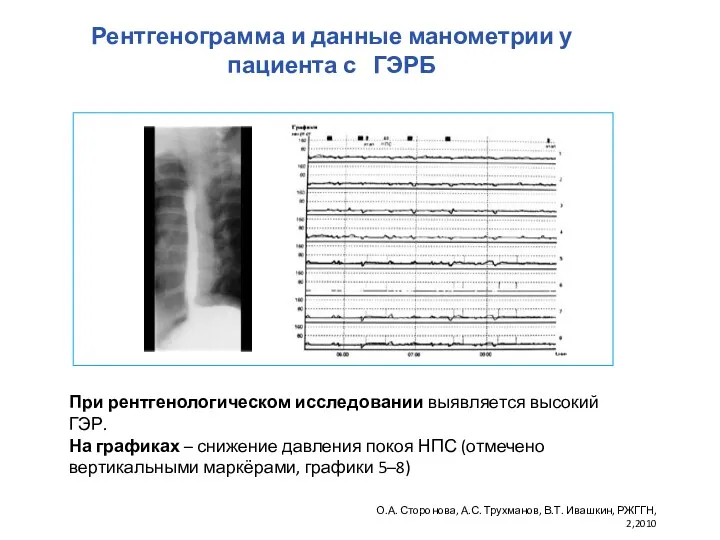 Рентгенограмма и данные манометрии у пациента с ГЭРБ При рентгенологическом