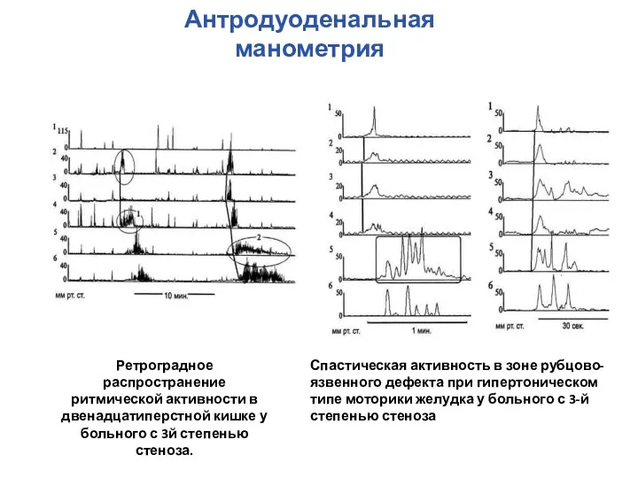 Ретроградное распространение ритмической активности в двенадцатиперстной кишке у больного с