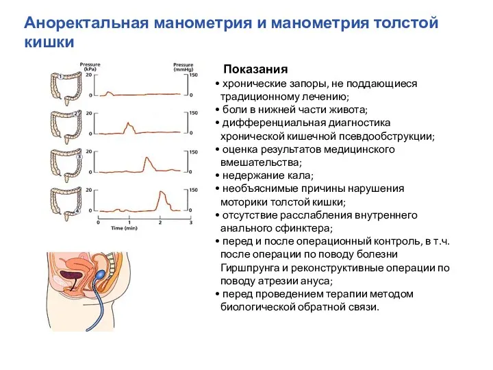 Аноректальная манометрия и манометрия толстой кишки Показания хронические запоры, не