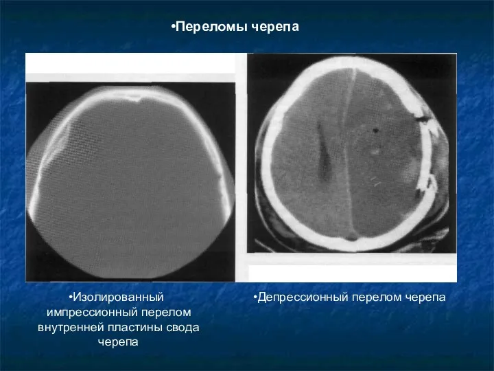 Изолированный импрессионный перелом внутренней пластины свода черепа Депрессионный перелом черепа Переломы черепа