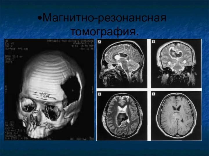 Магнитно-резонансная томография.