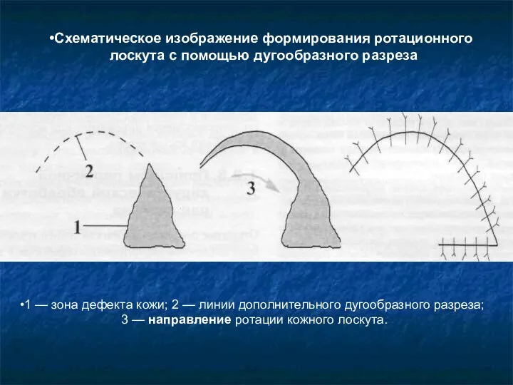 1 — зона дефекта кожи; 2 — линии дополнительного дугообразного