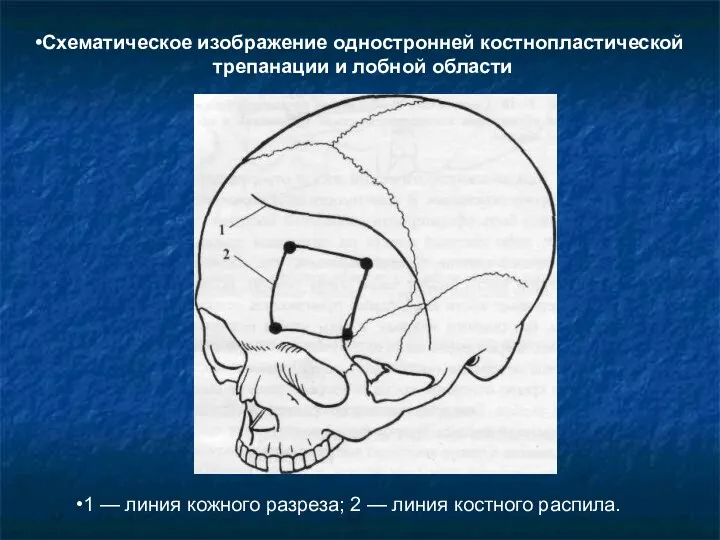 Схематическое изображение одностронней костно­пластической трепанации и лобной области 1 —