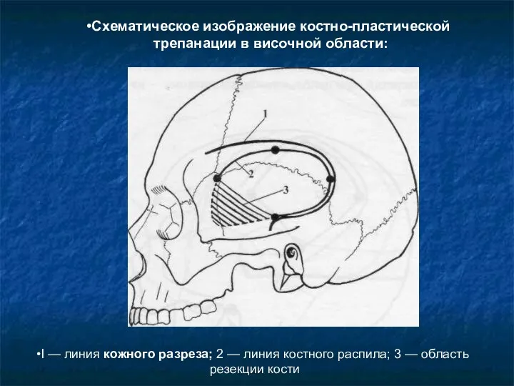 I — линия кожного разреза; 2 — линия костного распила;