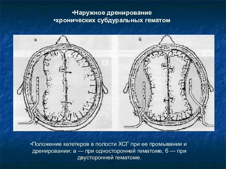 Наружное дренирование хронических субдуральных гематом Положение катетеров в полости ХСГ