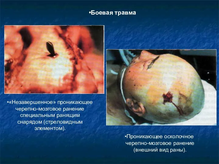«Незавершенное» проникающее черепно-мозговое ранение специальным ранящим снарядом (стреловидным элементом). Проникающее