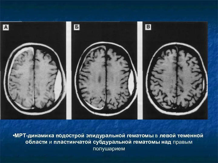 МРТ-динамика подострой эпидуральной гематомы в левой теменной области и пластинчатой субдуральной гематомы над правым полушарием