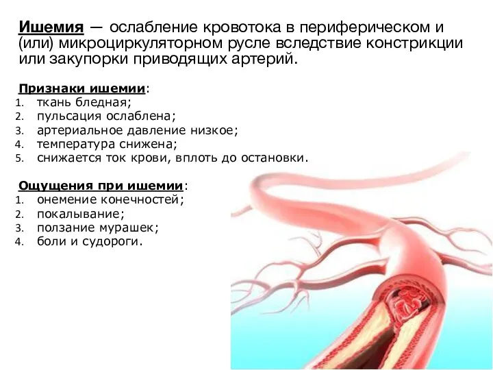 Ишемия — ослабление кровотока в периферическом и (или) микроциркуляторном русле вследствие констрикции или