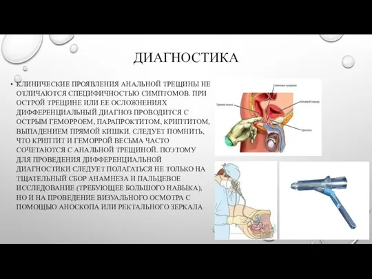 ДИАГНОСТИКА КЛИНИЧЕСКИЕ ПРОЯВЛЕНИЯ АНАЛЬНОЙ ТРЕЩИНЫ НЕ ОТЛИЧАЮТСЯ СПЕЦИФИЧНОСТЬЮ СИМПТОМОВ. ПРИ