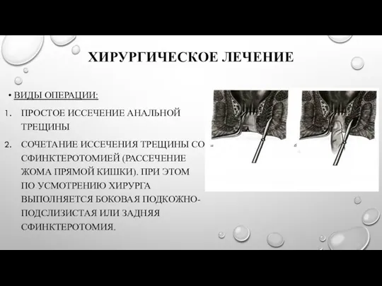 ХИРУРГИЧЕСКОЕ ЛЕЧЕНИЕ ВИДЫ ОПЕРАЦИИ: ПРОСТОЕ ИССЕЧЕНИЕ АНАЛЬНОЙ ТРЕЩИНЫ СОЧЕТАНИЕ ИССЕЧЕНИЯ