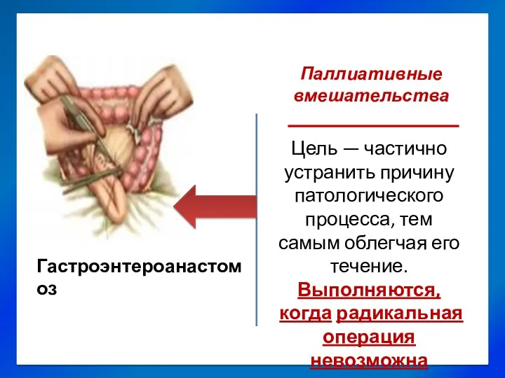 Гастроэнтероанастомоз. Паллиативные вмешательства Цель — частично устранить причину патологического процесса,