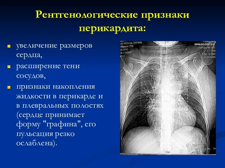Рентгенологические признаки перикардита: увеличение размеров сердца, расширение тени сосудов, признаки