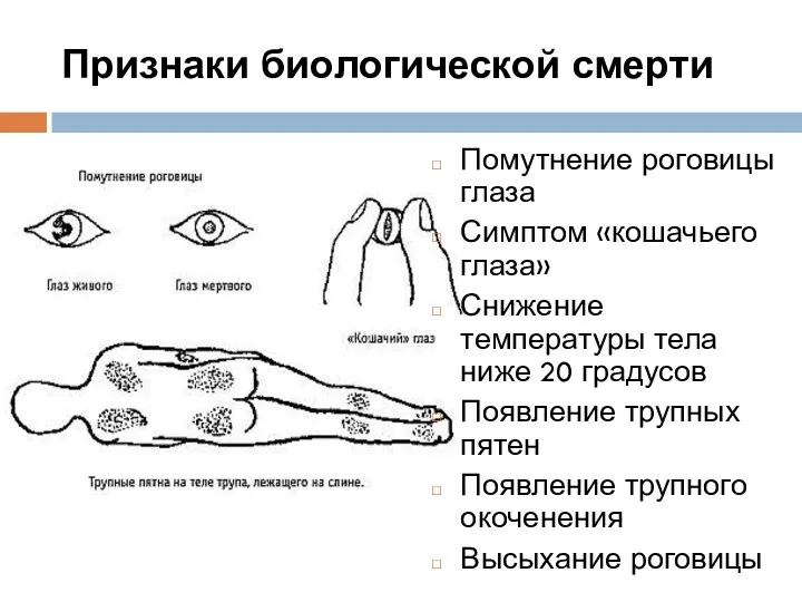 Признаки биологической смерти Помутнение роговицы глаза Симптом «кошачьего глаза» Снижение