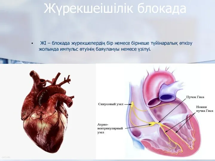 Жүрекшеішілік блокада ЖІ – блокада жүрекшелердің бір немесе бірнеше түйінаралық