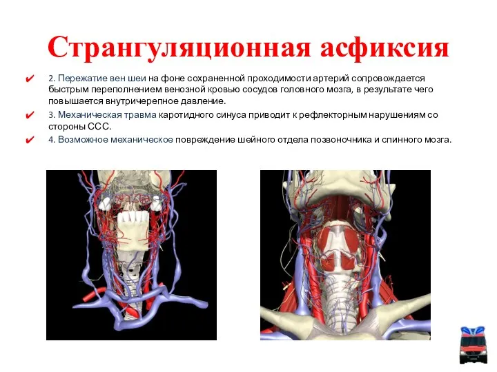 Странгуляционная асфиксия 2. Пережатие вен шеи на фоне сохраненной проходимости