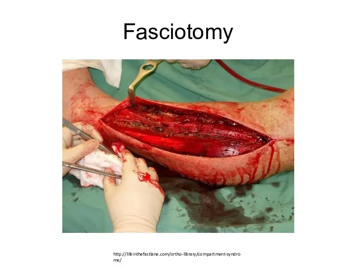 Fasciotomy http://lifeinthefastlane.com/ortho-library/compartment-syndrome/