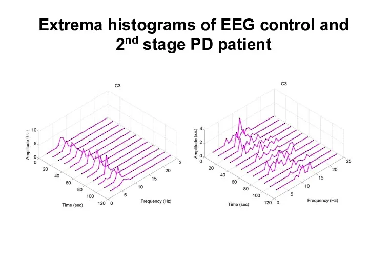 Extrema histograms of EEG control and 2nd stage PD patient