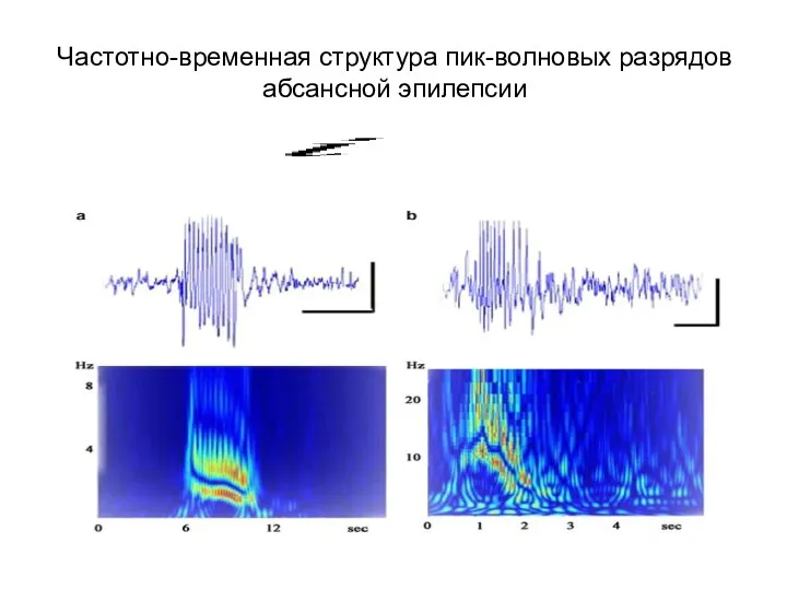 Частотно-временная структура пик-волновых разрядов абсансной эпилепсии