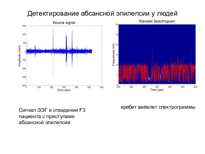 Детектирование абсансной эпилепсии у людей хребет вейвлет спектрограммы Сигнал ЭЭГ