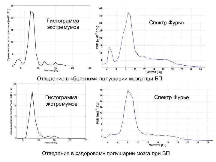 Отведение в «больном» полушарии мозга при БП Отведение в «здоровом»