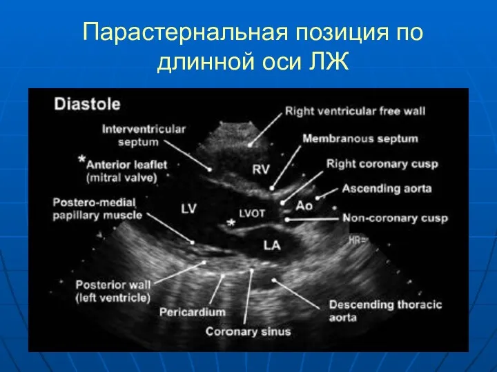 Парастернальная позиция по длинной оси ЛЖ