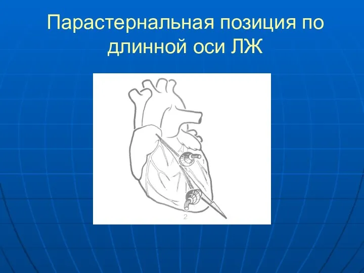 Парастернальная позиция по длинной оси ЛЖ