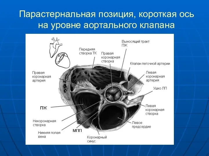 Парастернальная позиция, короткая ось на уровне аортального клапана