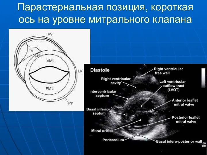 Парастернальная позиция, короткая ось на уровне митрального клапана