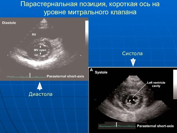 Парастернальная позиция, короткая ось на уровне митрального клапана Диастола Систола