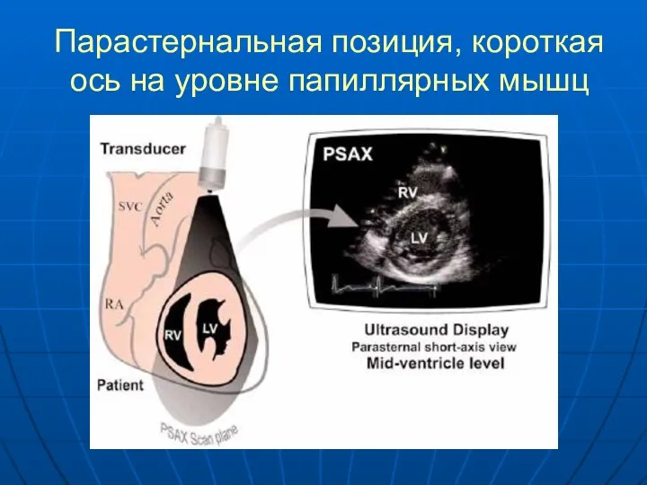 Парастернальная позиция, короткая ось на уровне папиллярных мышц