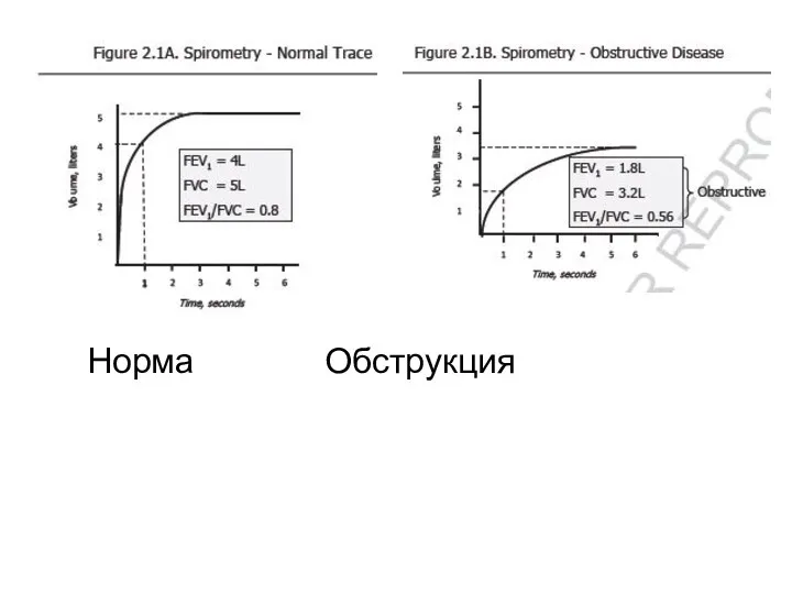 Норма Обструкция