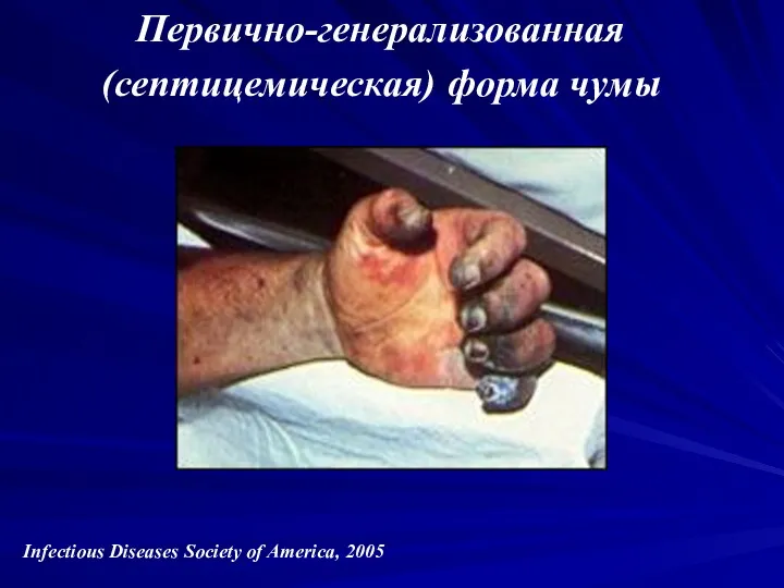 Первично-генерализованная (септицемическая) форма чумы Infectious Diseases Society of America, 2005