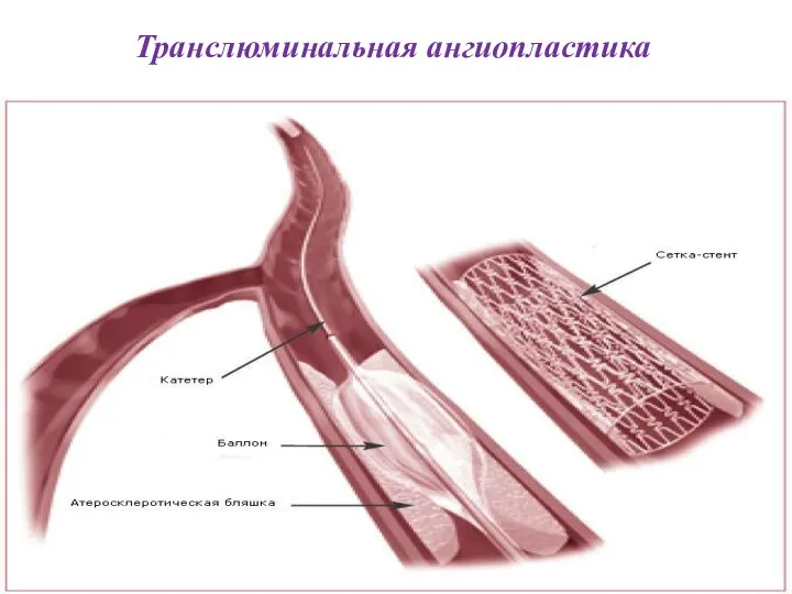 Транслюминальная ангиопластика