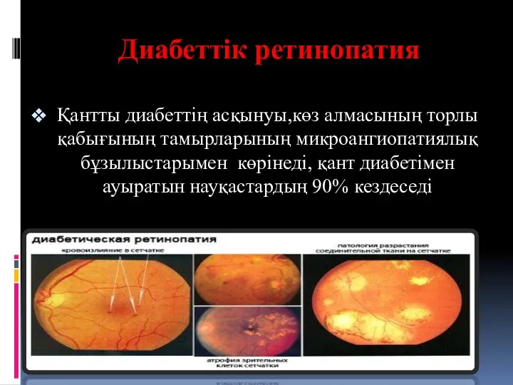 Диабеттік ретинопатия Қантты диабеттің асқынуы,көз алмасының торлы қабығының тамырларының микроангиопатиялық