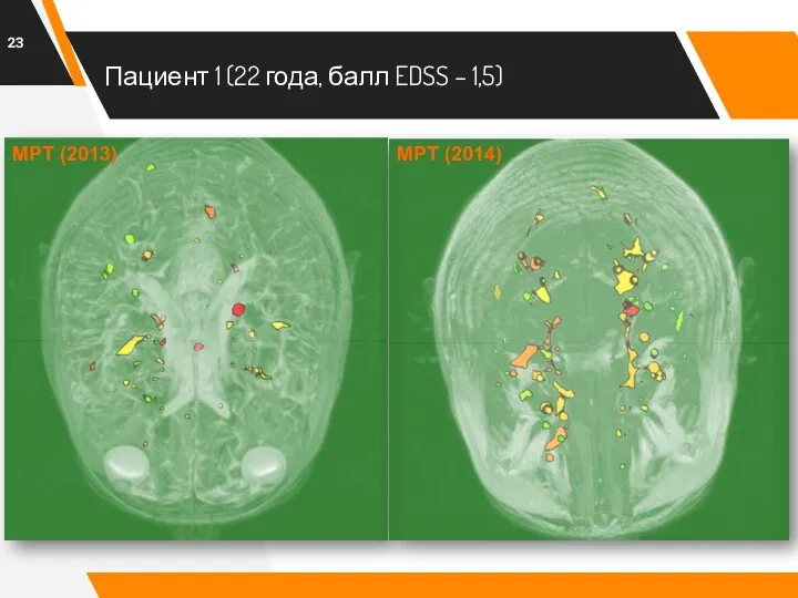 Пациент 1 (22 года, балл EDSS – 1,5) МРТ (2013) МРТ (2014)